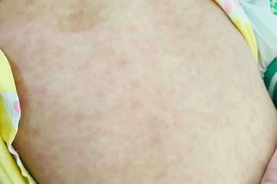 Ba trẻ tử vong nghi do sốt phát ban