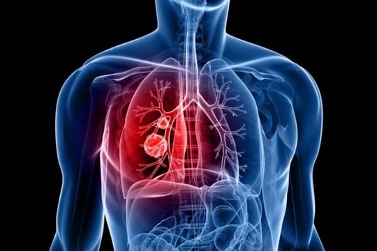 Vaccine điều trị ung thư phổi của Cuba giúp tăng tỷ lệ sống sót lên hơn 85%