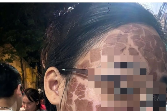 Một phụ nữ ở Bình Giang bị tăng sắc tố, giãn mao mạch da mặt sau khi làm đẹp tại cơ sở thẩm mỹ