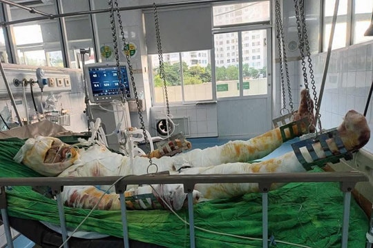 Chung tay níu giữ sự sống cho nam sinh viên Đại học Sao Đỏ bị bỏng nặng