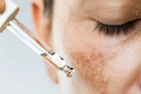 Những điều không nên bỏ qua khi điều trị nám da