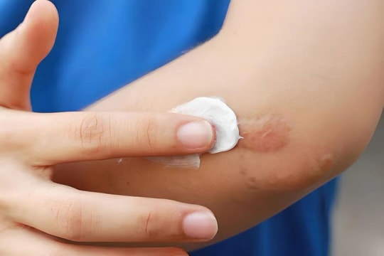 Bộ Y tế đình chỉ, thu hồi toàn quốc Gel Promed ngừa sẹo của Công ty Starmed