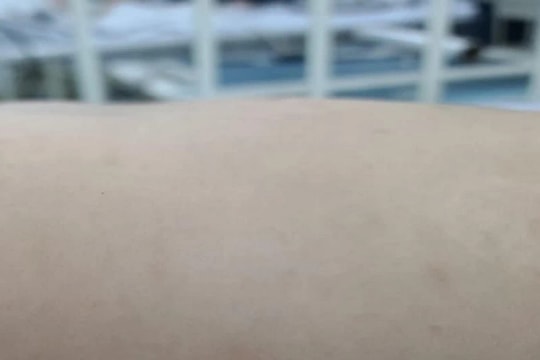 Cảnh báo về bệnh sốt mò dễ nhầm với cúm, có thể gây tổn thương gan, viêm màng não