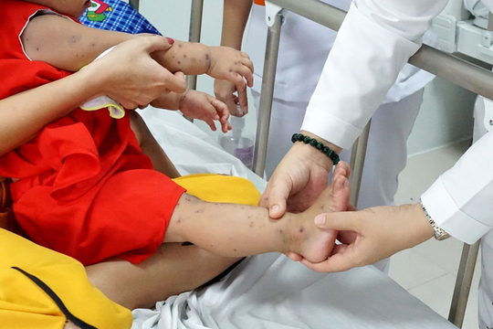 Bộ Y tế yêu cầu tăng cường thu dung, điều trị và kiểm soát bệnh tay chân miệng