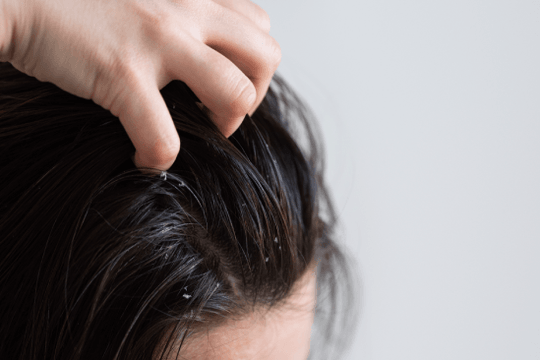 Mẹo đơn giản giúp giảm gàu trên tóc