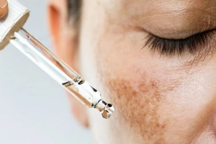 Những điều không nên bỏ qua khi điều trị nám da