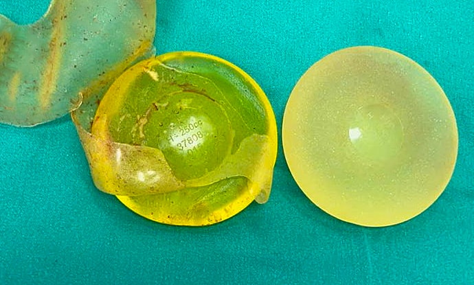 Người đặt túi ngực silicon sau bao lâu nên kiểm tra định kỳ?