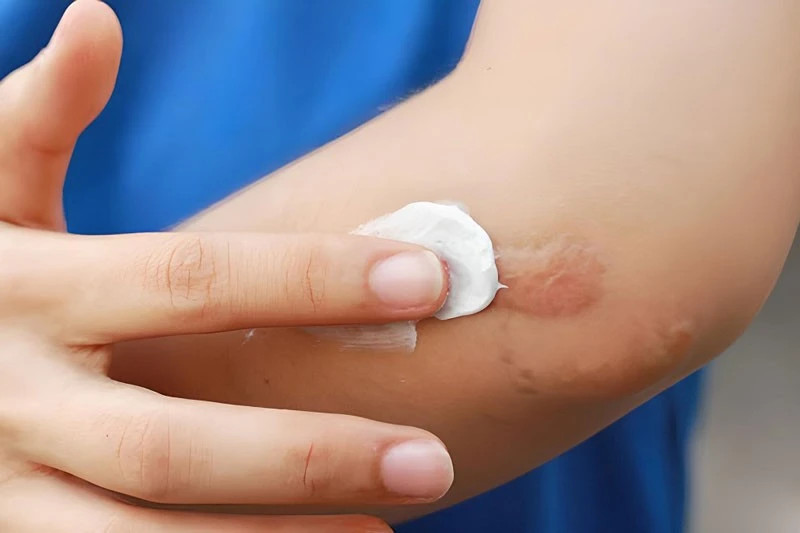 Bộ Y tế đình chỉ, thu hồi toàn quốc Gel Promed ngừa sẹo của Công ty Starmed