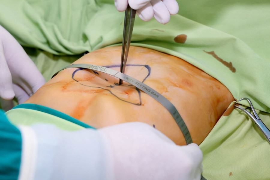 Lõm ngực bẩm sinh, căn bệnh dễ bị bỏ qua
