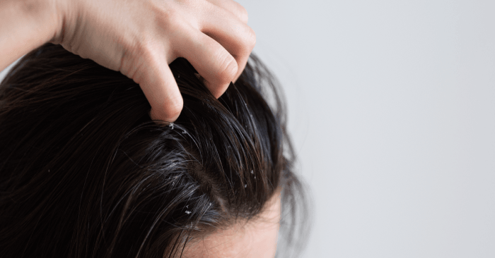 Mẹo đơn giản giúp giảm gàu trên tóc